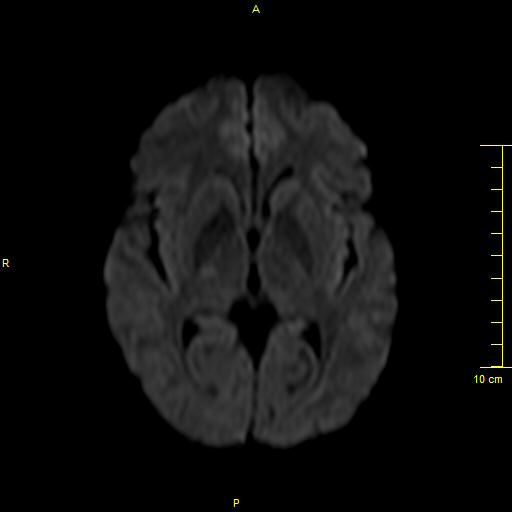 File:Cerebral venous thrombosis (Radiopaedia 23288-23351 Axial DWI 19).JPG