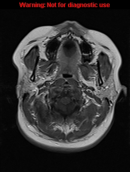 File:Cerebral venous thrombosis (Radiopaedia 37224-39208 Axial T1 C+ 2).jpg