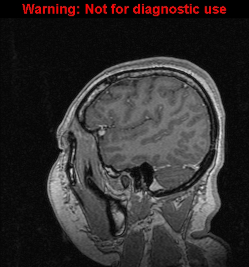 Cerebral venous thrombosis (Radiopaedia 37224-39208 Sagittal T1 C+ 122).jpg