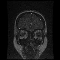 Cerebral venous thrombosis - ulcerative colitis (Radiopaedia 66049-75219 Coronal MRV 98).jpg