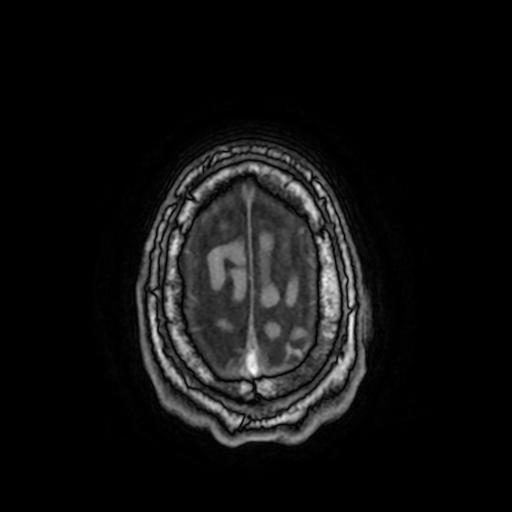 File:Cerebral venous thrombosis with secondary intracranial hypertension (Radiopaedia 89842-106957 Axial T1 153).jpg