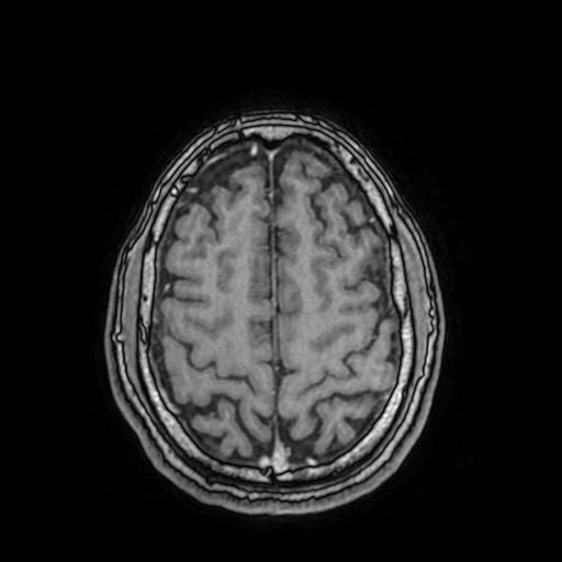 File:Cerebral venous thrombosis with secondary intracranial hypertension (Radiopaedia 89842-106957 Axial T1 C+ 134).jpg