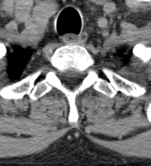 Cervical canal stenosis due to ossification of the posterior longitudinal ligament (Radiopaedia 47260-51823 Axial non-contrast 56).png