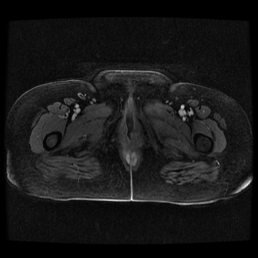 Cervical carcinoma (Radiopaedia 70924-81132 Axial T1 C+ fat sat 17).jpg