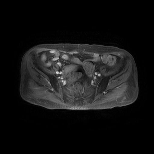 File:Cervical carcinoma (Radiopaedia 78847-91705 Axial T1 C+ fat sat 5).jpg
