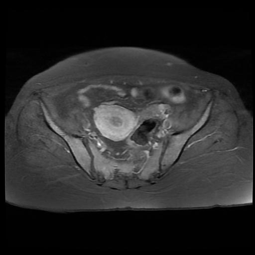 File:Cervical carcinoma (Radiopaedia 88010-104555 Axial T1 C+ fat sat 7).jpg
