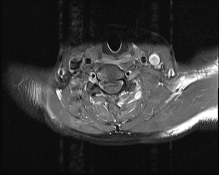 File:Cervical disc extrusion (Radiopaedia 53950-60077 Axial T1 C+ fat sat 17).jpg