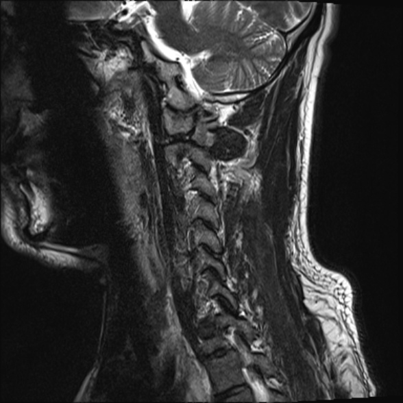 File:Cervical disc extrusion (Radiopaedia 53950-60077 Sagittal T2 15).jpg