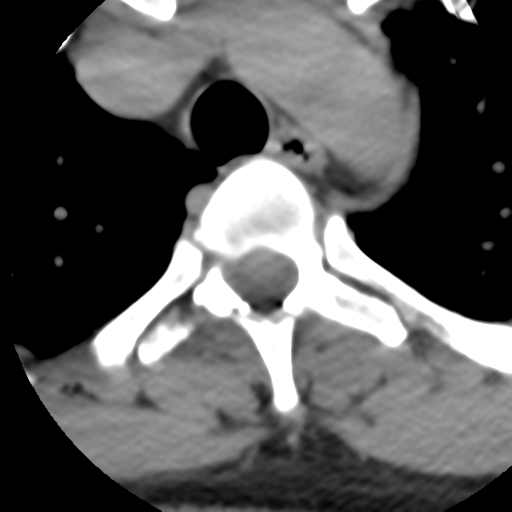 File:Cervical schwannoma (Radiopaedia 57979-64974 Axial non-contrast 72).png