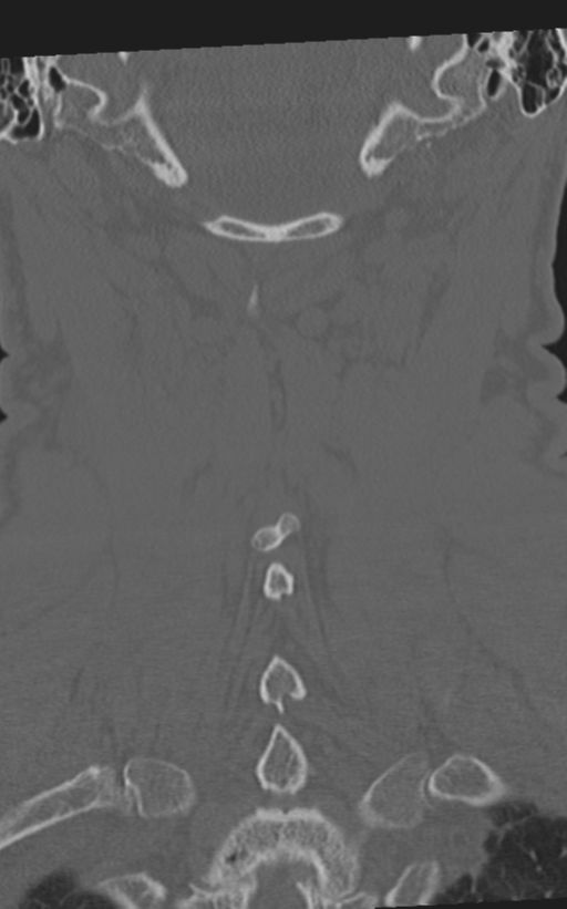 Cervical spine fractures with vertebral artery dissection (Radiopaedia 53296-59268 Coronal bone window 55).png