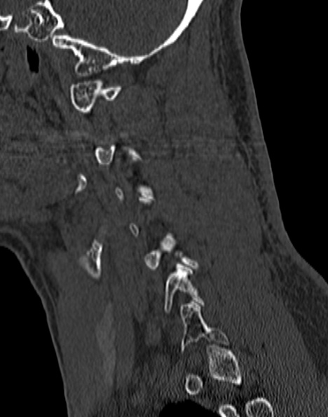 Cervical spondylodiscitis (Radiopaedia 28057-29489 Sagittal bone window 21).jpg