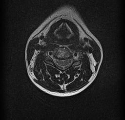 File:Cervical spondylodiscitis and calvarial hemangioma (Radiopaedia 64317-73104 Axial T2 7).jpg