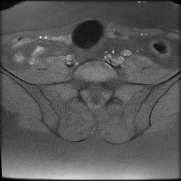 File:Cesarean scar ectopic pregnancy (Radiopaedia 77286-89362 Axial T1 fat sat 2).jpg