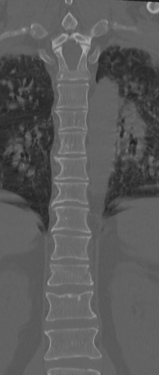 Chance fracture (Radiopaedia 33854-35020 Coronal bone window 43).png