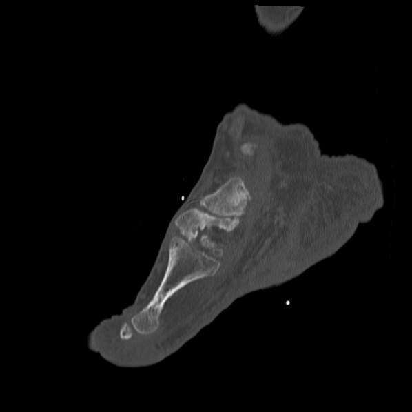Charcot joint (Radiopaedia 36629-38194 Sagittal bone window 68).jpg