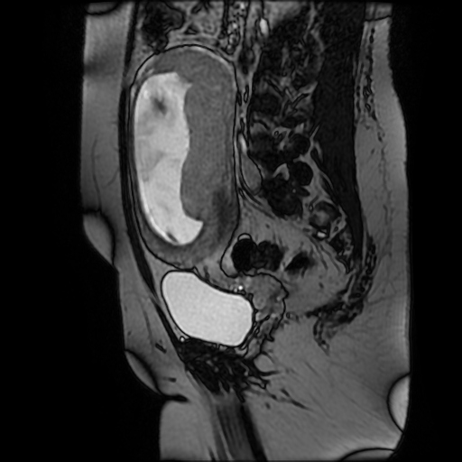 File:Chiari II malformation - fetal MRI (Radiopaedia 68099-77581 Sagittal Fiesta 35).jpg