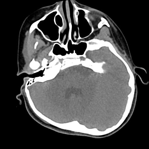 Chiari I with syrinx and skull base anomalies (Radiopaedia 89444-106412 Axial non-contrast 19).jpg