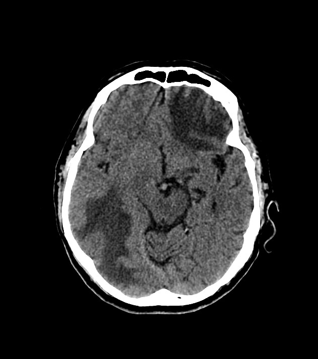 Cholangiocarcinoma with cerebral metastases (Radiopaedia 83519-98628 Axial non-contrast 30).jpg
