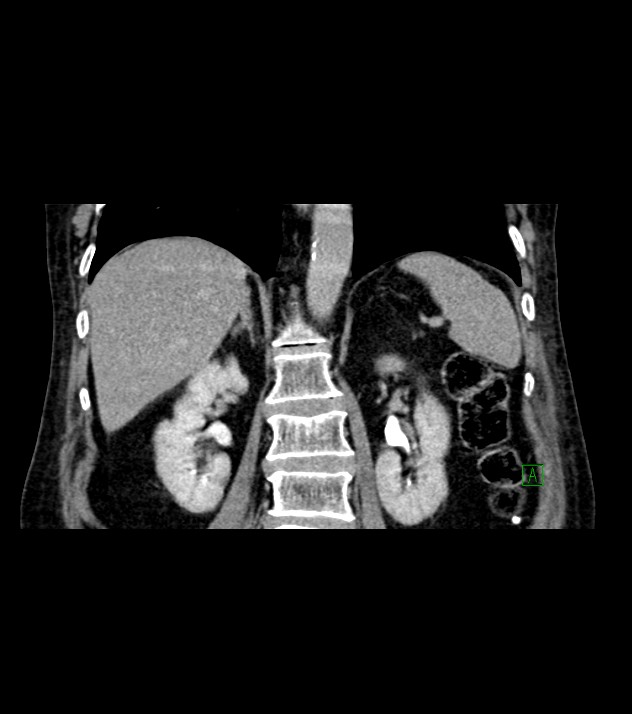 Cholangiocarcinoma with cerebral metastases (Radiopaedia 83519-98629 Coronal C+ delayed 53).jpg