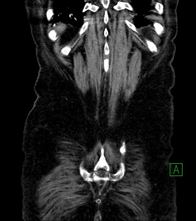 Cholangiocarcinoma with cerebral metastases (Radiopaedia 83519-98629 E 79).jpg