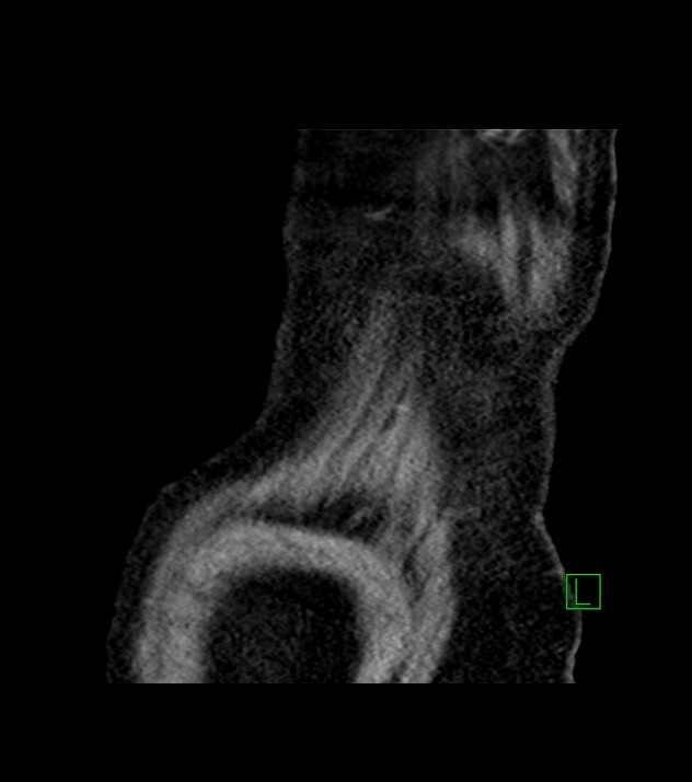 Cholangiocarcinoma with cerebral metastases (Radiopaedia 83519-98629 Sagittal C+ delayed 105).jpg