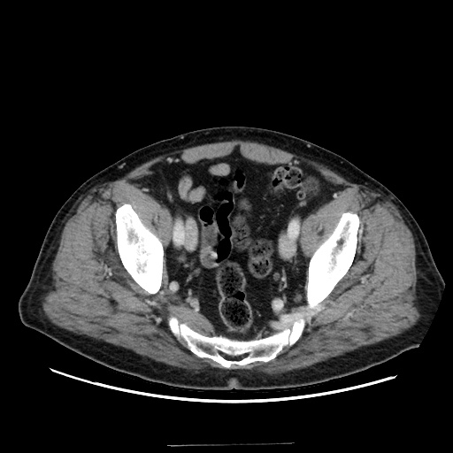 Choledocholiathiasis with normal caliber common bile duct (Radiopaedia 75368-86632 A 163).jpg