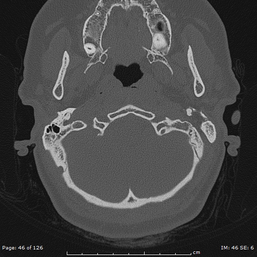 Cholesteatoma - external auditory canal (Radiopaedia 88452-105096 Axial bone window 9).jpg