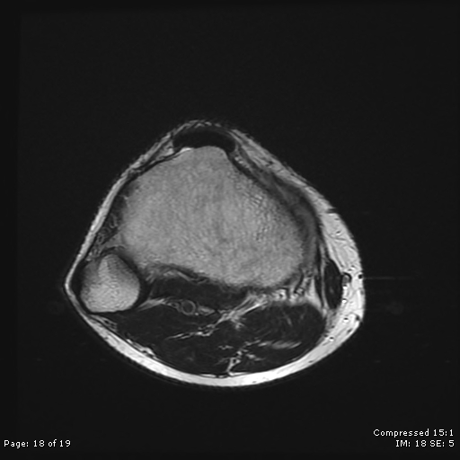 File:Chondroblastoma (Radiopaedia 25725-25891 Axial T2 18).jpg