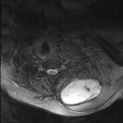 File:Chondrosarcoma - chest wall (Radiopaedia 65192-74200 Axial Gradient Echo 14).jpg