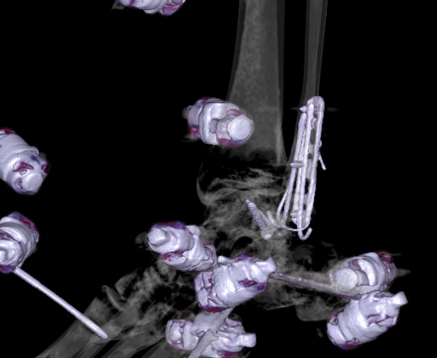 File:Chopart fracture (Radiopaedia 35347-36861 3D MPR bone window 7).jpg