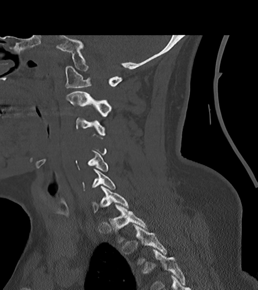 File:Chordoma (C4 vertebra) (Radiopaedia 47561-52188 Sagittal bone window 49).png