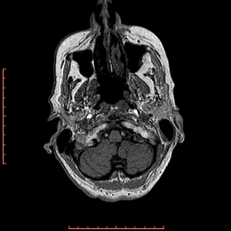 Choroid plexus xanthogranuloma (Radiopaedia 67843-77270 Axial T1 145).jpg