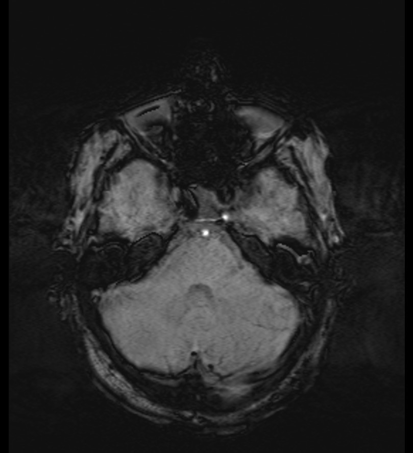Choroid plexus xanthogranuloma (Radiopaedia 91271-108875 Axial SWI 18).jpg