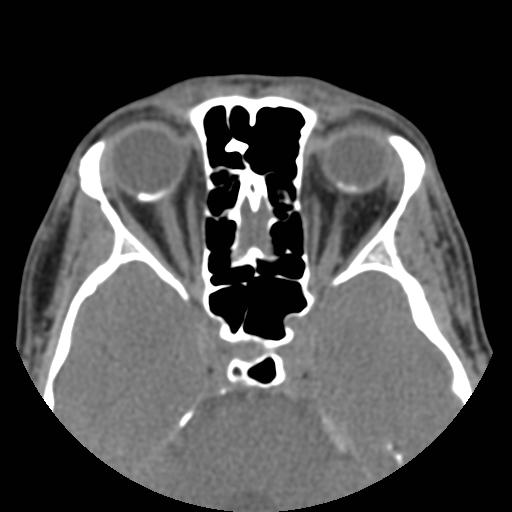 File:Choroidal osteoma (bilateral) (Radiopaedia 23284-23343 Axial non-contrast 1).jpg