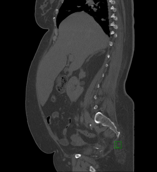 Chromophobe renal cell carcinoma (Radiopaedia 84239-99519 Sagittal bone window 68).jpg