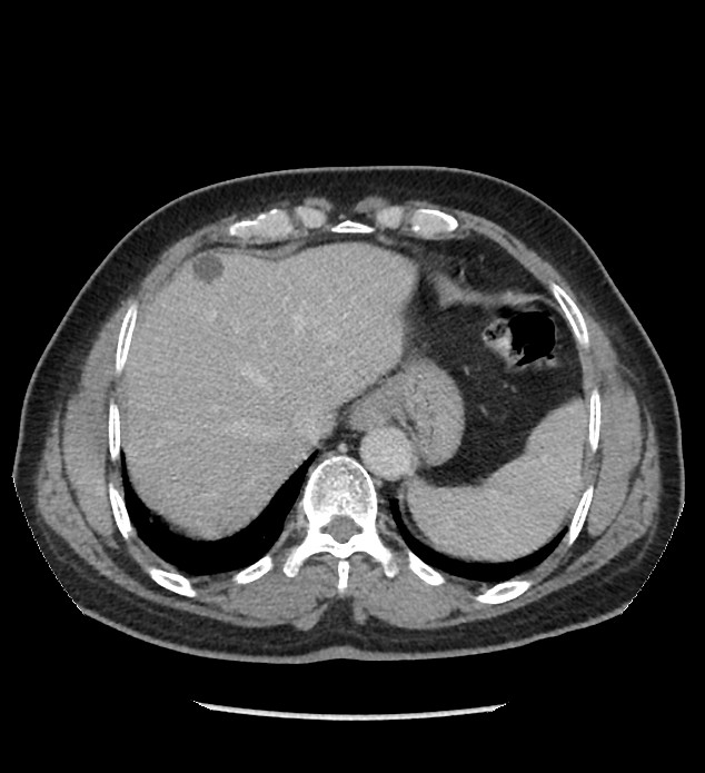 Chromophobe renal cell carcinoma (Radiopaedia 86879-103083 C 18).jpg
