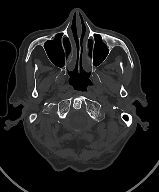 Chronic bilateral subdural hygroma (Radiopaedia 85801-101623 Axial bone window 110).jpg