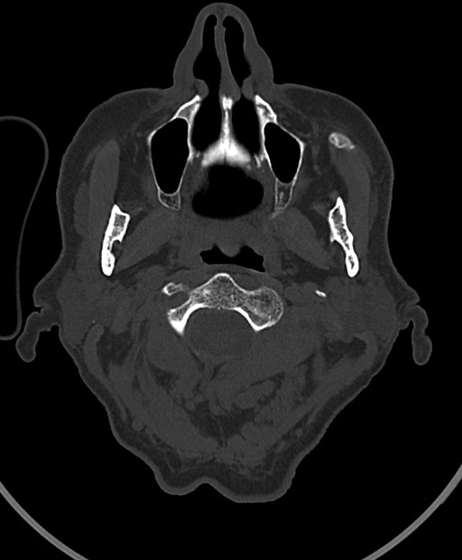 Chronic bilateral subdural hygroma (Radiopaedia 85801-101623 Axial bone window 121).jpg