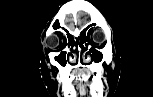 Chronic invasive fungal sinusitis (Radiopaedia 91563-109286 D 3).jpg