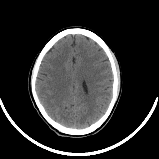 Chronic invasive fungal sinusitis with intraorbital and intracranial extension (Radiopaedia 56387-63046 Axial non-contrast 247).jpg