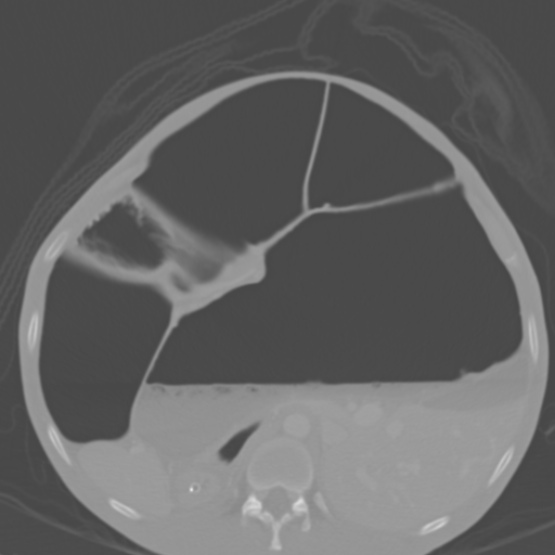 Chronic large bowel pseudo-obstruction (Radiopaedia 43181-46492 Axial bone window 64).jpg