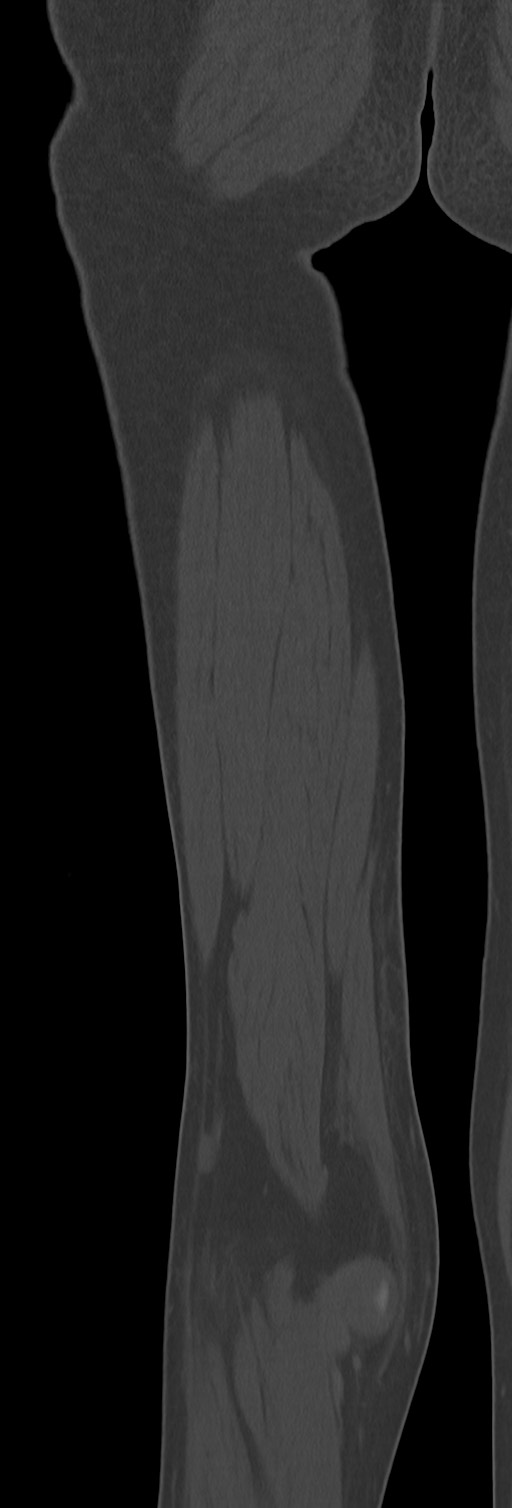 Chronic ostemyelitis of the femur with long sinus tract (Radiopaedia 74947-85982 Coronal bone window 68).jpg