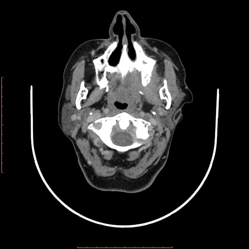 File:Chronic osteomyelitis - maxilla (Radiopaedia 23783-23927 B 70).jpg