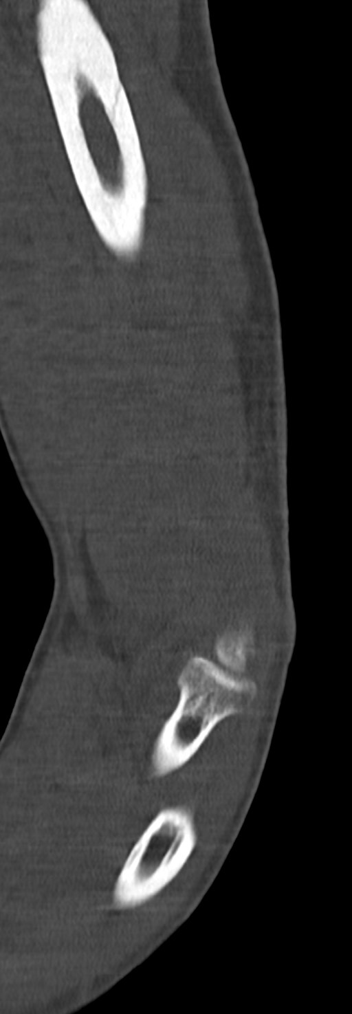Chronic osteomyelitis of the distal humerus (Radiopaedia 78351-90971 Sagittal bone window 41).jpg
