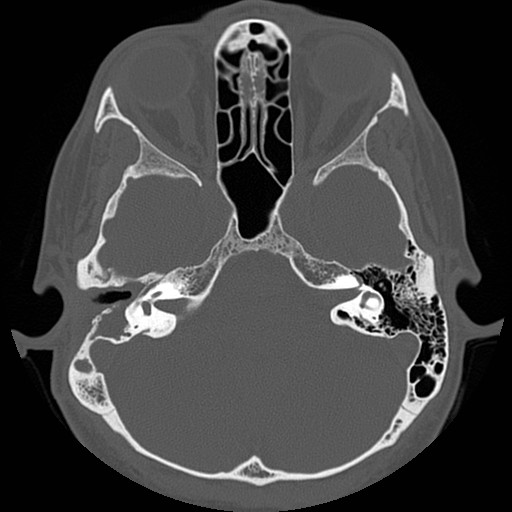File:Chronic otomastoiditis (Radiopaedia 27138-27309 Axial bone window 36).jpg
