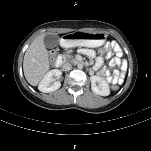 Chronic pancreatitis (Radiopaedia 64576-73450 C 61).jpg