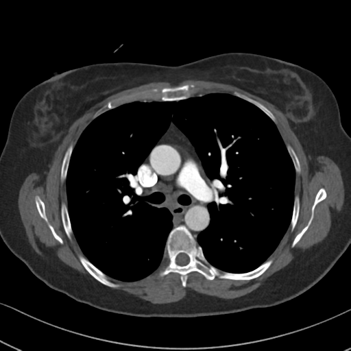 Chronic pulmonary embolus (Radiopaedia 39129-41341 Axial C+ CTPA 43).png