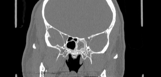 Chronic sphenoidal sinusitis (Radiopaedia 62030-70122 Coronal bone window 108).jpg