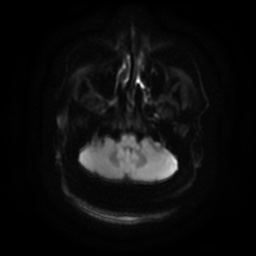 Chronic submandibular sialadenitis (Radiopaedia 61852-69885 Axial DWI 4).jpg