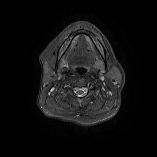 File:Chronic submandibular sialadenitis (Radiopaedia 61852-69885 Axial STIR 13).jpg